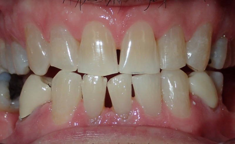 Full Arch Implant Dentures