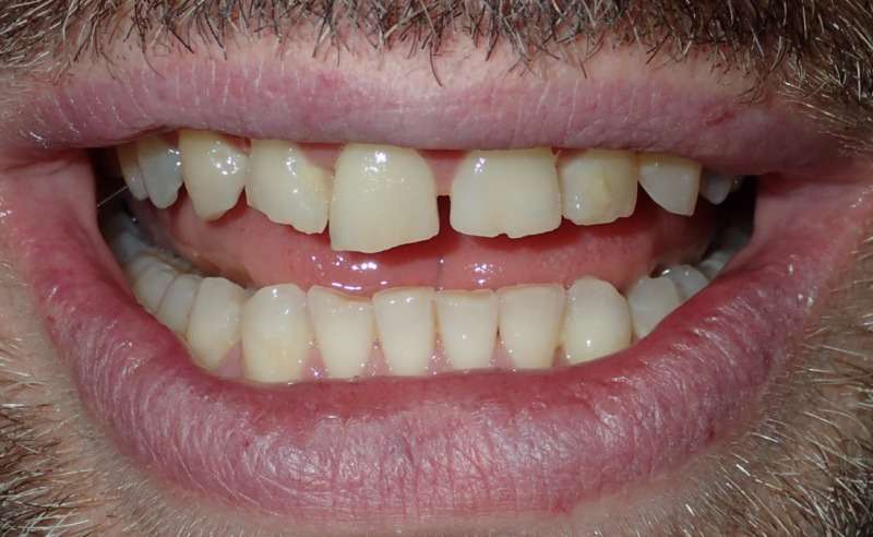 Full Arch Implant Dentures