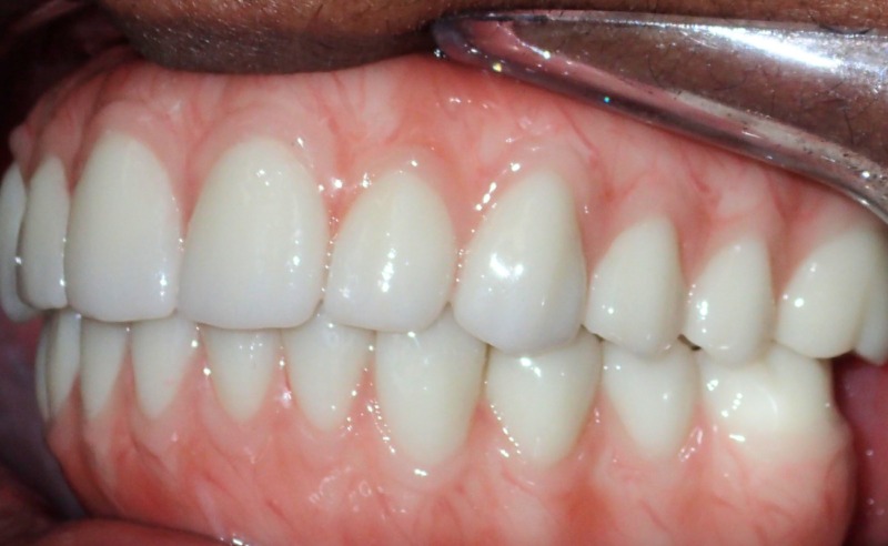 Full Arch Implant Dentures