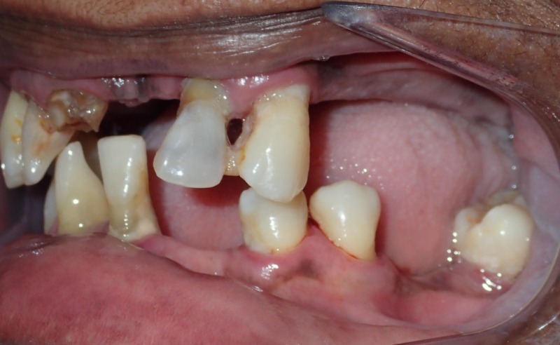 Full Arch Implant Dentures