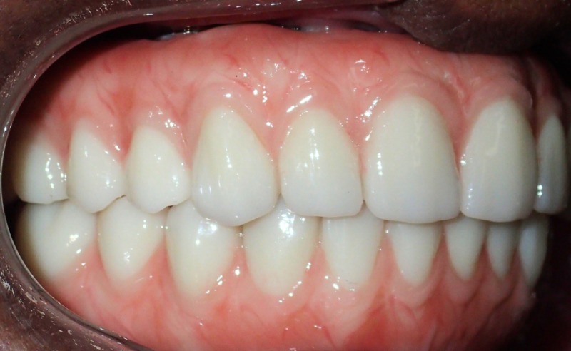 Full Arch Implant Dentures