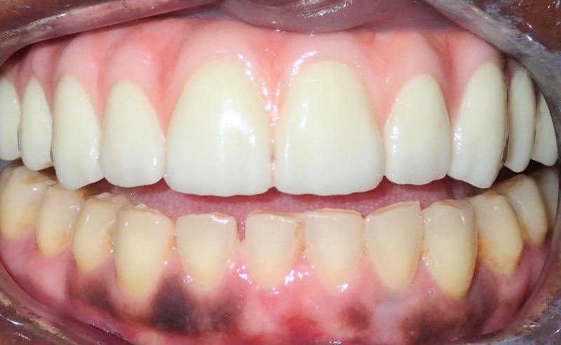 Full Arch Implant Dentures