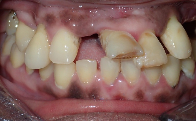 Full Arch Implant Dentures