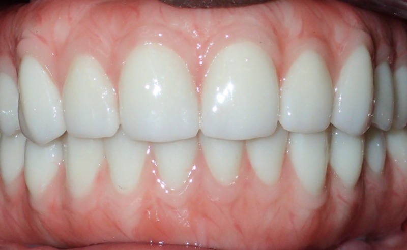 Full Arch Implant Dentures