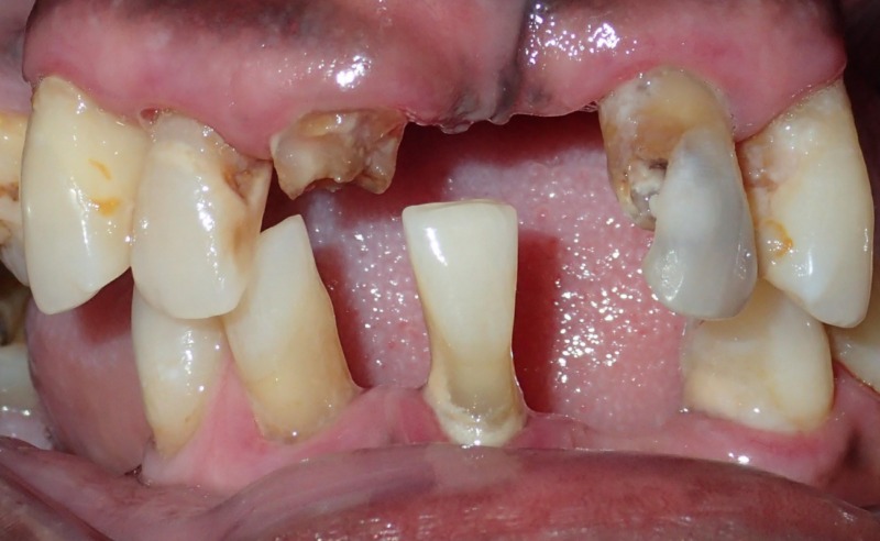 Full Arch Implant Dentures