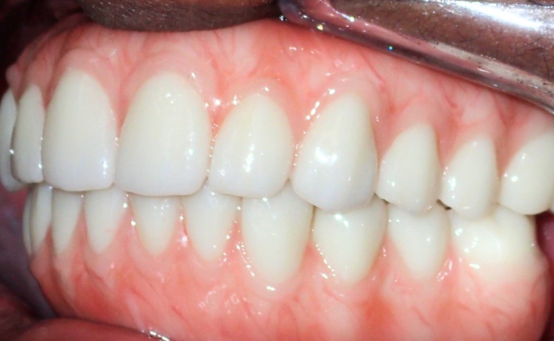 Full Arch Implant Dentures