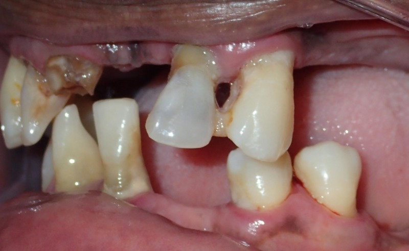 Full Arch Implant Dentures