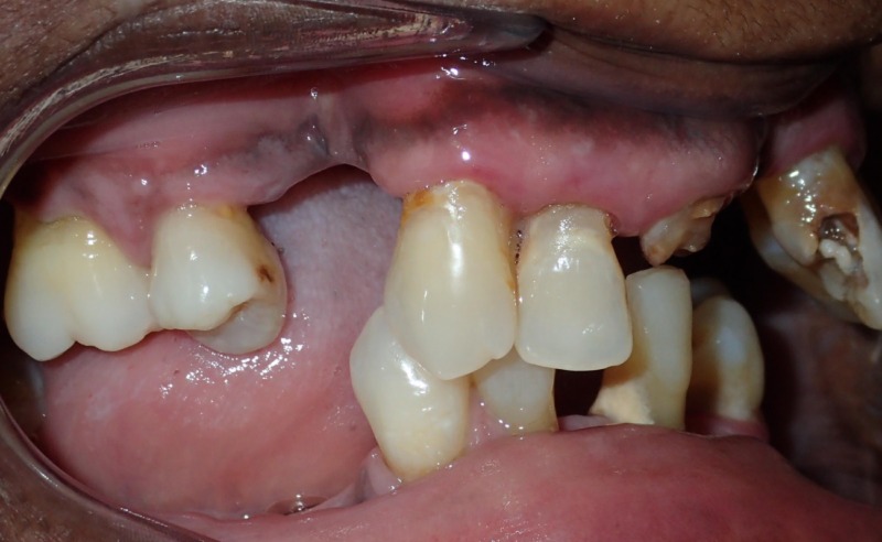 Full Arch Implant Dentures